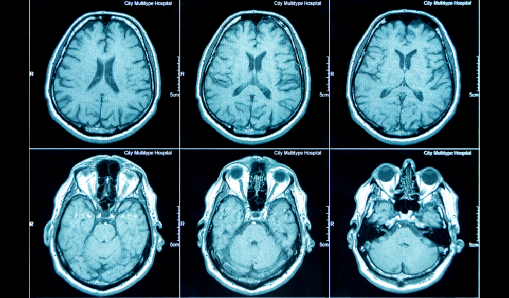 Hirnscans einer depressiven Person