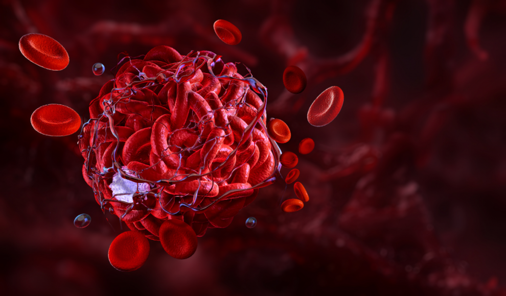 Venöse Thromboembolie (VTE) durch Luftschadstoffe